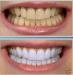 sbiancamento denti