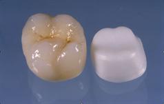 capsula per denti  metal-free