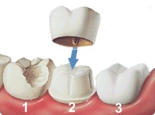 CORONA CERAMICA