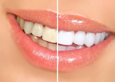 Denti bianchi: sbiancamento dentale
