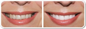 trattamento denti da sbiancare