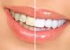 Denti bianchi: sbiancamento dentale